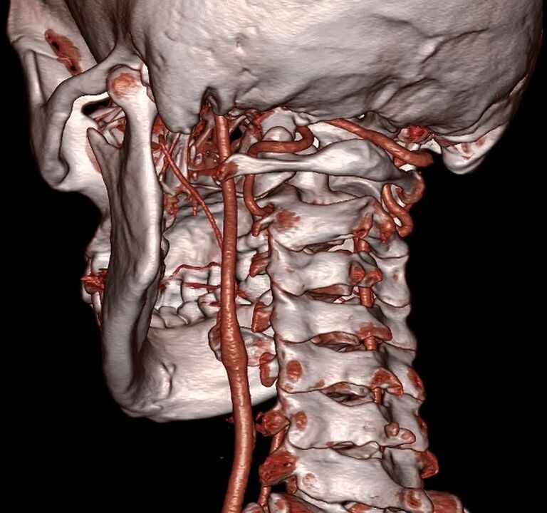 eingeklemmte Arterie mit zervikaler Osteochondrose
