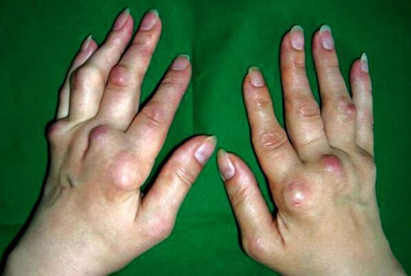 Von deformierende Polyosteoarthritis betroffene Hände