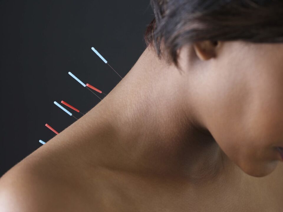 Akupunktur bei zervikaler Osteochondrose beseitigt entzündliche Prozesse