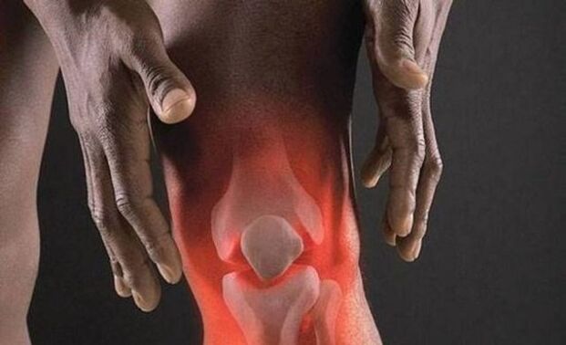 Arthrose wird von einem Entzündungsprozess im Kniegelenk begleitet