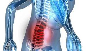 Anzeichen und Symptome einer lumbalen Osteochondrose